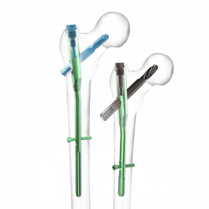 New Technology CE ISO Orthopedic Trauma Bone Titanium Implants PFNA Intramedullary Nail