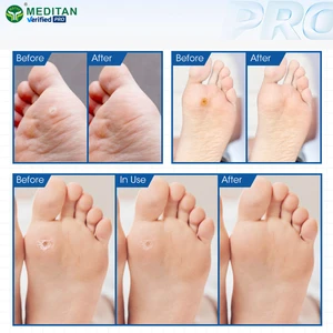 OEM/ODM Skin Care Mild Formula Salicylic Acid Phenol Foot Corn Remover Pads Scar-Free 6Pcs/Box No Pain Class I Medical Device