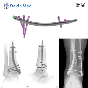 Sistema De Clavo Intramedular De Tibia Bloqueado Precio De Mayorista OEM/ODM CE ISO