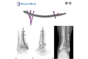 Sistema De Clavo Intramedular De Tibia Bloqueado Precio De Mayorista OEM/ODM CE ISO